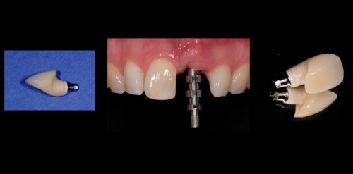 Choice of type of fixation: screw-retained vs. cemented reconstructions 